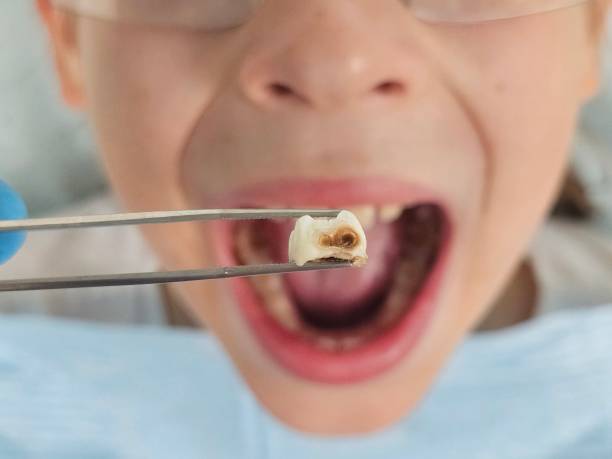 Best Emergency Dental Extractions in Ellwood City, PA